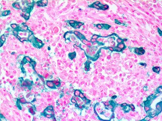 IHC of EpCAM on an FFPE Colon Carcinoma Tissue